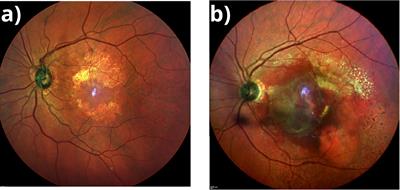 MicroRNAs as potential biomarkers and therapeutic targets in age-related macular degeneration